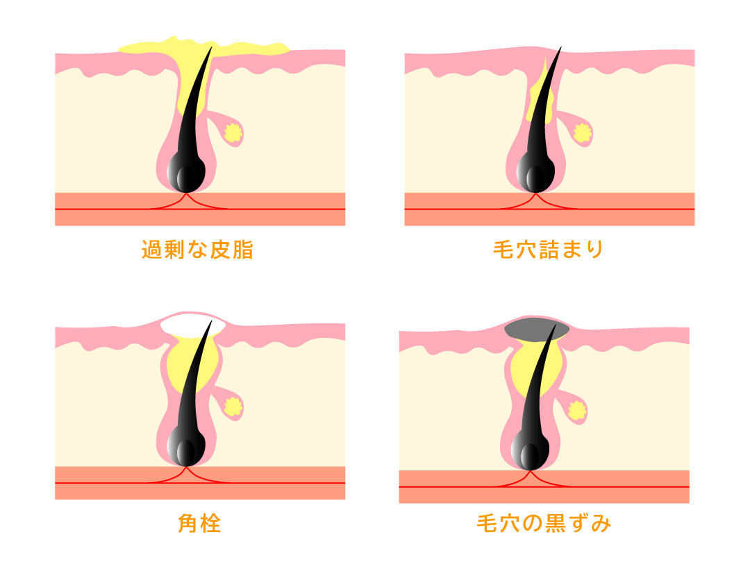 黒ずみ小鼻 ぽっかり毛穴とサヨナラしてsns映えする理想の毛穴レス美肌に